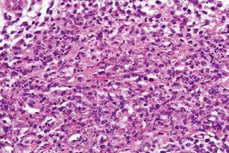 Fig. 15.18, Sweet syndrome: the infiltrate consists largely of neutrophils. There is edema and marked leukocytoclasis.