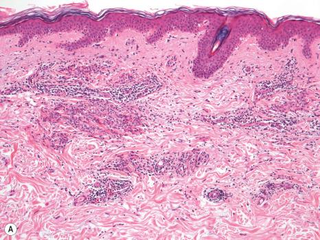 Fig. 15.19, ( A , B ) Histiocytoid Sweet syndrome: the proliferation is characterized by immature myeloid cells that resemble histiocytes.