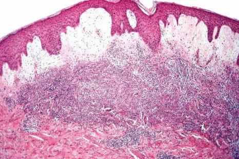 Fig. 15.20, Sweet syndrome: marked papillary dermal edema is commonly present and sometimes this is associated with subepidermal vesiculation.