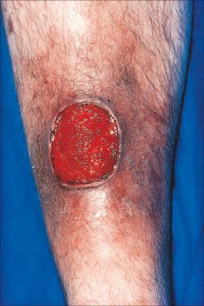 Fig. 15.2, Pyoderma gangrenosum: this shows an area of ulceration with a typical undermined purplish border.