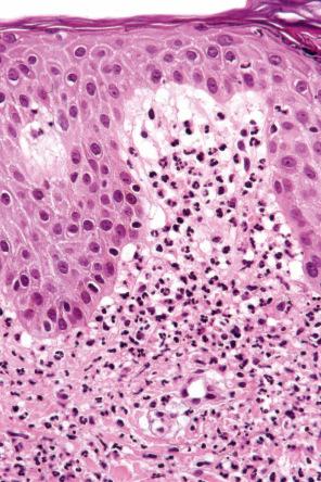 Fig. 15.21, Sweet syndrome: the occasional presence of dermal papillary neutrophil microabscesses can result in confusion with dermatitis herpetiformis.