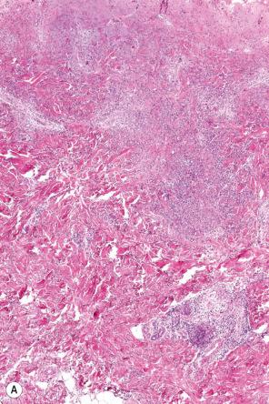 Fig. 15.22, ( A , B ) Neutrophilic dermatosis associated with gastrointestinal disease: there is an intense dermal neutrophilic infiltrate indistinguishable from Sweet syndrome.