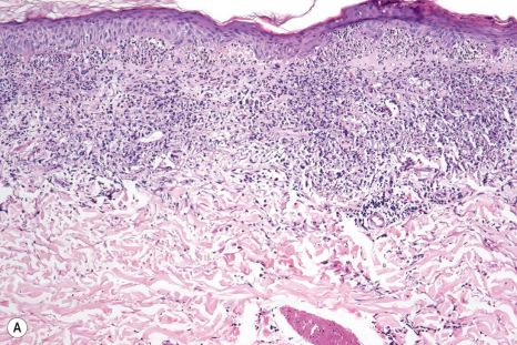 Fig. 15.23, ( A , B ) Rheumatoid neutrophilic dermatitis: there is an intense upper dermal neutrophilic infiltrate with conspicuous karyorrhexis.