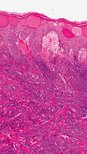 Fig. 15.24, Rheumatoid neutrophilic dermatosis: in some cases, there is prominent spongiosis of the epidermis with microvesicale formation.