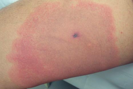Fig. 15.26, Spider bite: note the central eschar and surrounding erythema.