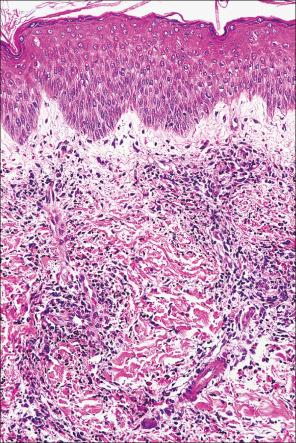 Fig. 15.27, Arthropod bite reaction: there is a heavy perivascular and interstitial infiltrate.