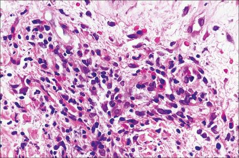 Fig. 15.28, Arthropod bite reaction: note the conspicuous eosinophils.