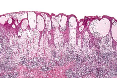 Fig. 15.29, Bullous arthropod bite reaction: massive subepidermal edema has resulted in a multiloculated subepidermal blister.