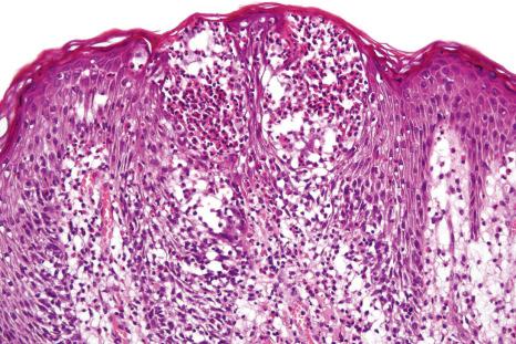 Fig. 15.30, Bullous arthropod bite reaction: eosinophilic spongiosis is present at the edge of the lesion.