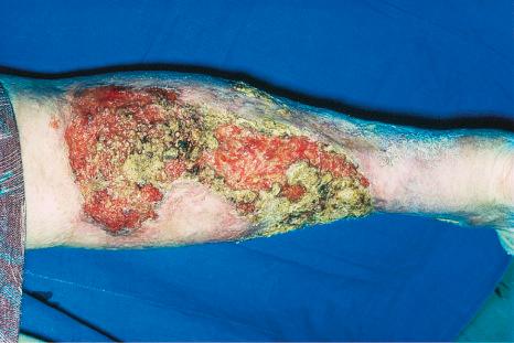 Fig. 15.3, Pyoderma gangrenosum: an extensive lesion with marked crusting and undermining in the proximal and medial margins.
