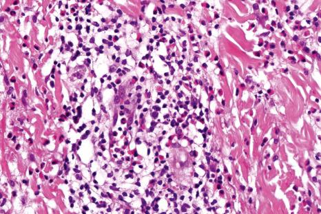 Fig. 15.31, Bullous arthropod bite reaction: there is a lymphocytic and eosinophilic perivascular and interstitial infiltrate.