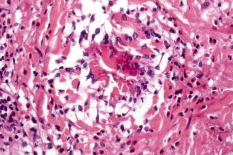 Fig. 15.32, Bullous arthropod bite reaction: high-power view showing a flame figure.