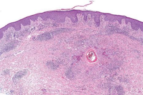 Fig. 15.33, Tick bite reaction: low-power view showing a heavy dermal inflammatory cell infiltrate. Tick parts are seen in the center of the field.