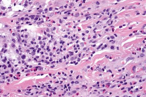 Fig. 15.35, Tick bite reaction: there is a dense infiltrate of lymphocytes, histiocytes, and conspicuous eosinophils.