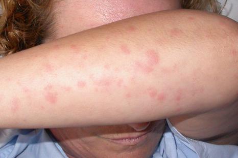 Fig. 15.36, Still disease in an adult: there are multiple erythematous macules.