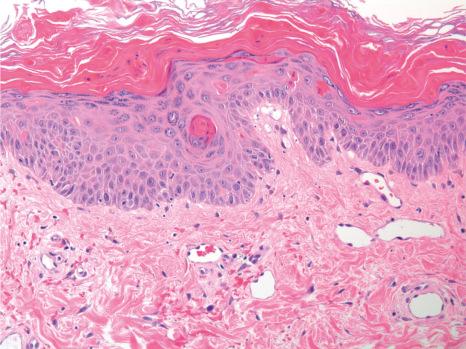 Fig. 15.37, Adult onset Still disease: there are numerous dyskeratotic cells in stratum corneum and upper epidermis.