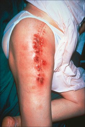 Fig. 15.4, Pyoderma gangrenosum: multiple early lesions at the site of previous surgery.
