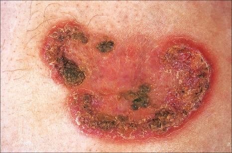 Fig. 15.5, Superficial granulomatous pyoderma: crusted superficial lesion with a cribriform appearance.