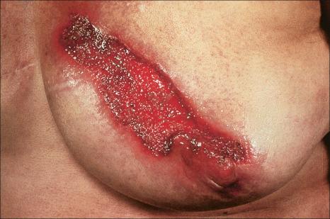 Fig. 15.6, Superficial granulomatous pyoderma: this field shows extensive ulceration of the breast.