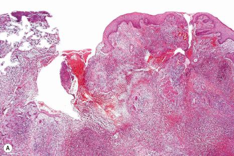 Fig. 15.7, ( A , B ) Pyoderma gangrenosum: in this biopsy from the edge of an ulcer, there are massive intradermal inflammatory changes, with abscess formation.