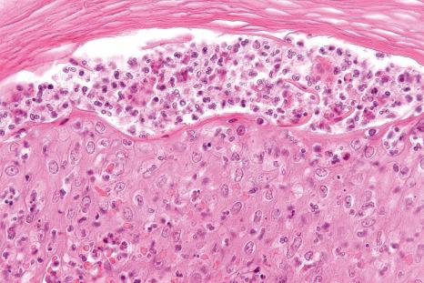 Fig. 15.8, Pyoderma gangrenosum: early acneiform lesion showing a subcorneal pustule.