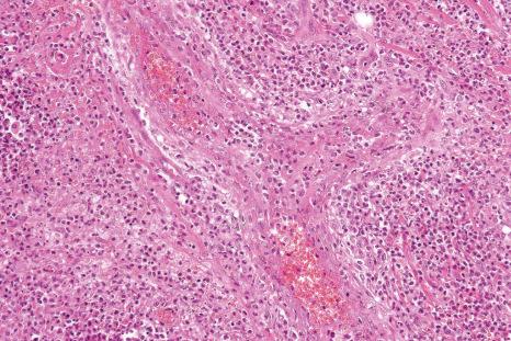 Fig. 15.9, Pyoderma gangrenosum: acute necrotizing vasculitis. It is likely that any active inflammation of the blood vessel walls is a result of the surrounding inflammation rather than its cause.