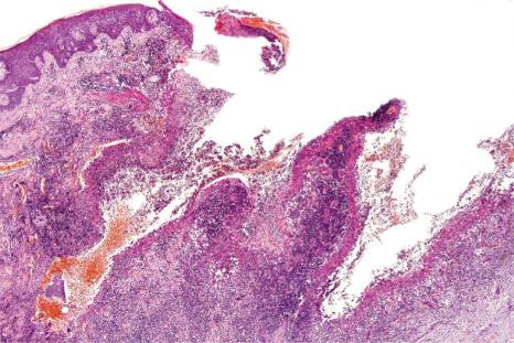 Fig. 15.10, Superficial granulomatous pyoderma: low-power view showing an undermining ulcer.