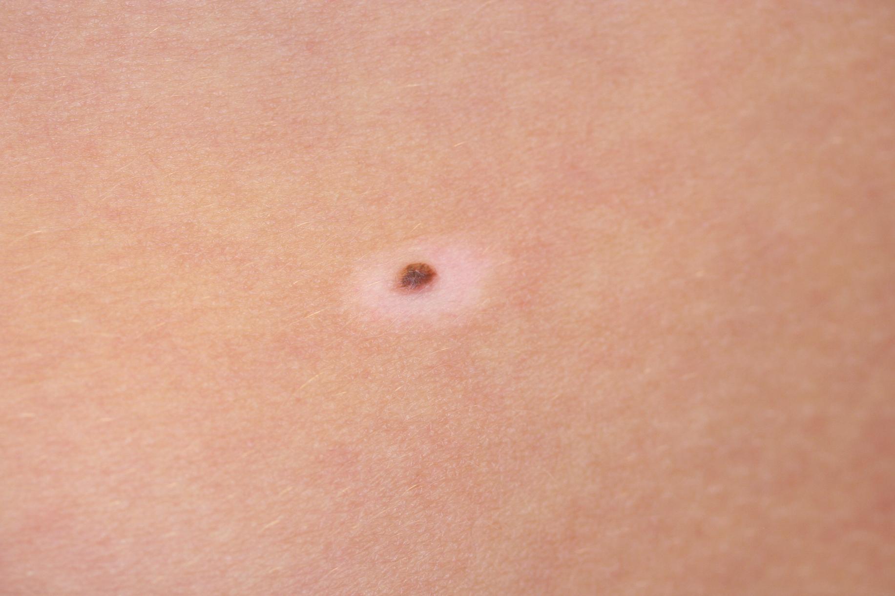 Fig. 70.3, The classic appearance of a halo nevus. These small pigmented lesions are surrounded by a rim of hypopigmentation. They are typically seen in adolescents and are most commonly located over the trunk, especially on the back. Treatment is usually not needed unless the pigmented portion of the halo nevus appears atypical. In that case, excision of the entire lesion, including the halo, is recommended.