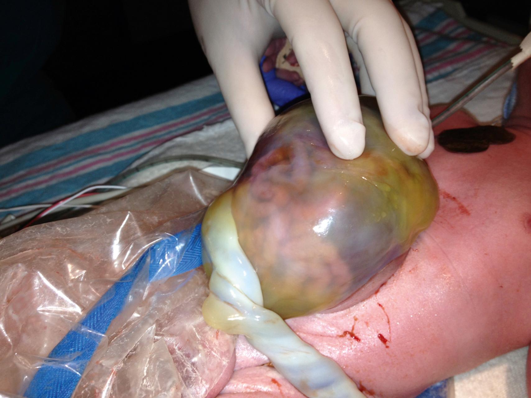 Fig. 58.1, Neonate Born With an Omphalocele With a Large Abdominal Wall Defect.