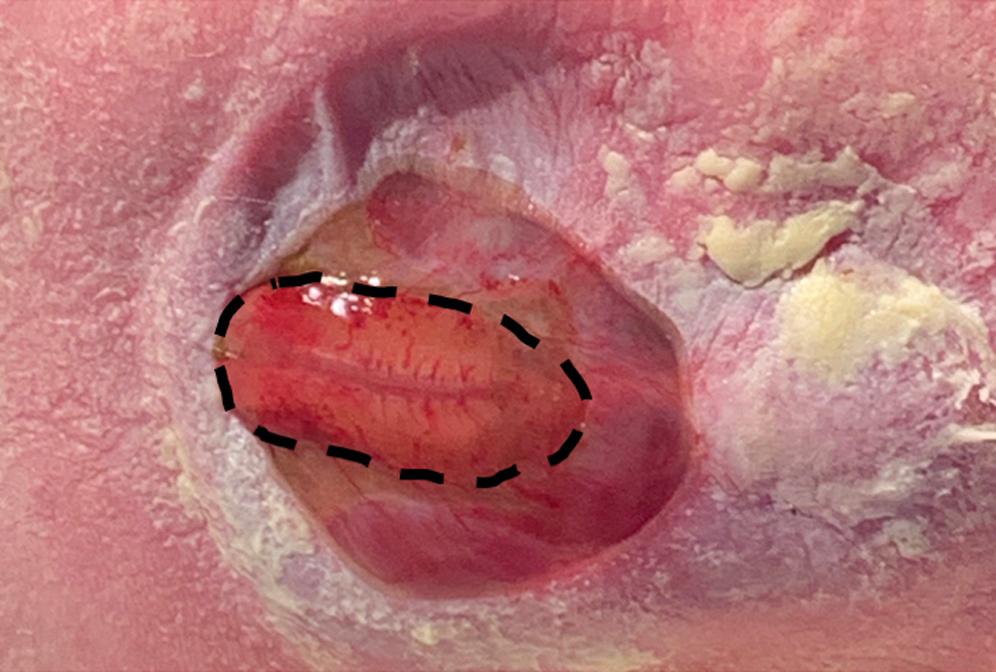 Fig. 48.1, Open myelomeningocele with placode (open neural elements, black dotted line).