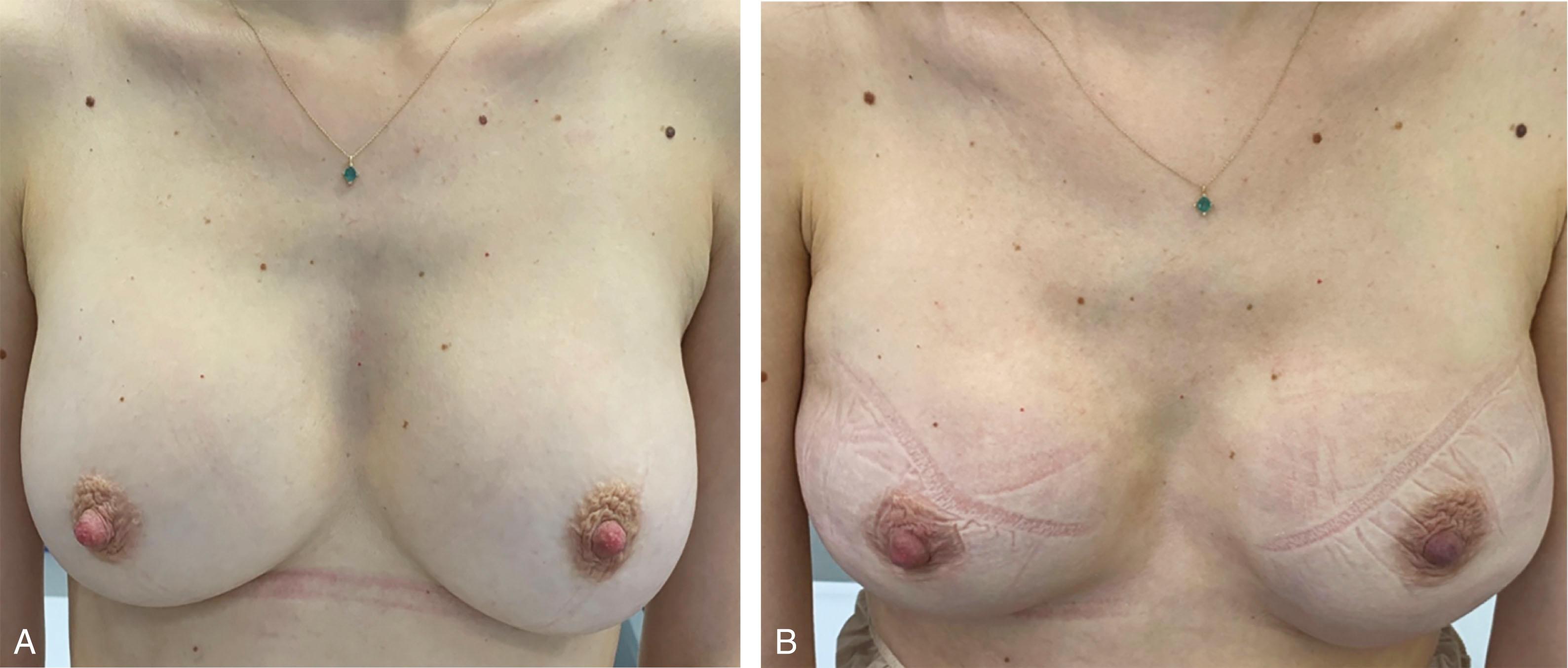 Fig. 43.1, NSM for risk reducing in a BRCA mutation carrier: (A) preop and (B) 4 weeks postop.