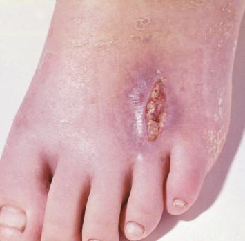 Figure 13-1, The Nocardia species most commonly responsible for lesions of the extremities, as demonstrated here, is N. brasiliensis.