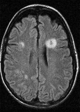 Figure 13-3, The most dreaded complication of pulmonary nocardiosis is dissemination to the brain, as demonstrated here.