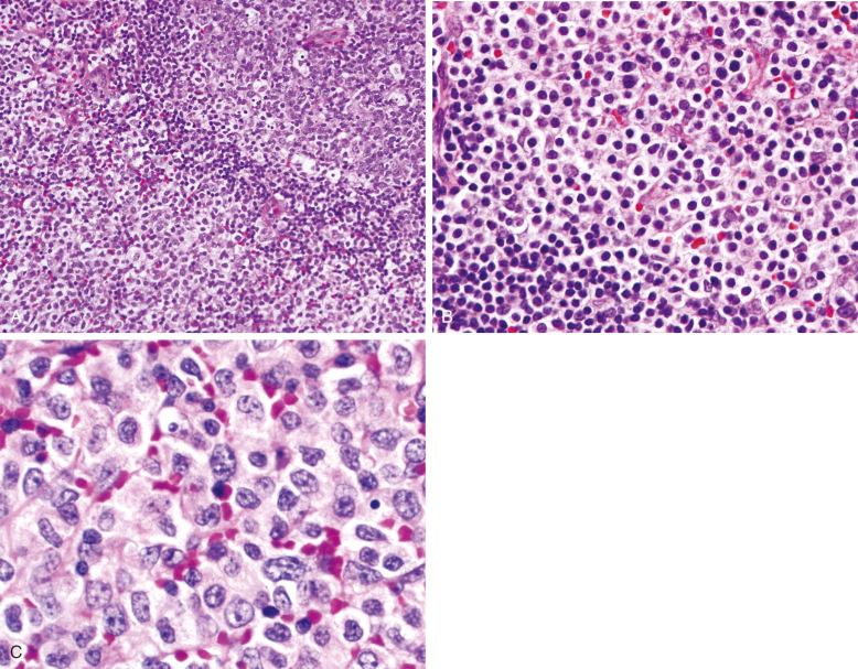 Figure 21-1, Nodal marginal zone lymphoma, mucosa-associated lymphoid tissue type.