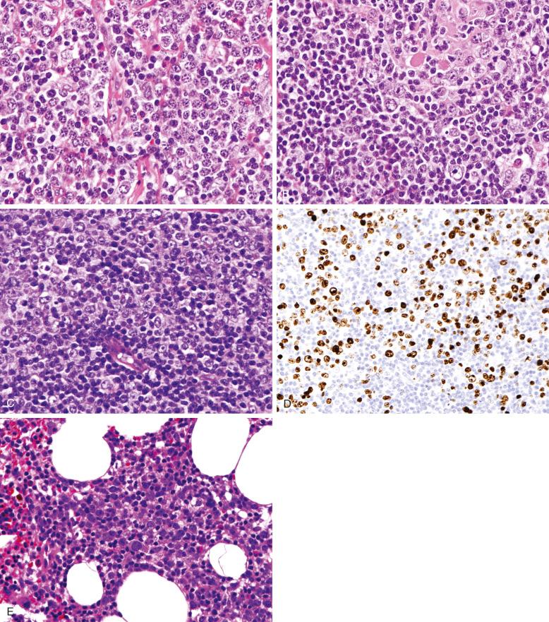 Figure 21-4, Varied cytologic composition of nodal marginal zone lymphoma (NMZL).