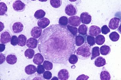 Nodular Lymphocyte–Predominant Hodgkin's Lymphoma - Clinical Tree