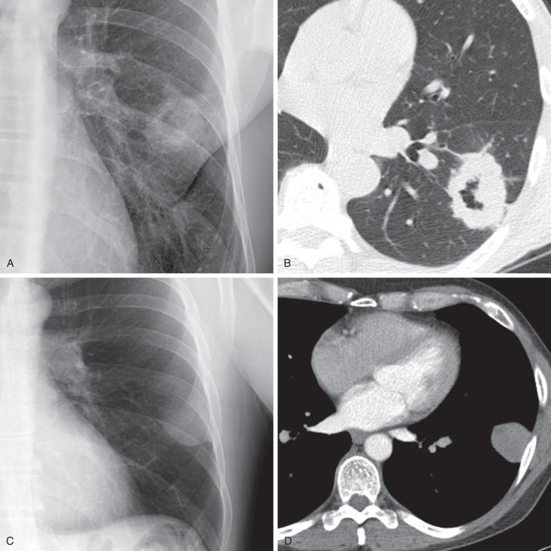 Fig. 4.1, Lung nodule or mass versus a pleural or chest wall nodule or mass. (A) Frontal chest radiograph shows a cavitary left lower lobe nodule. All the margins of the nodule are well seen, suggesting a lung origin. (B) Axial CT scan confirms the intraparenchymal location of the cavitary left lower lobe nodule in a man with lung cancer. (C) Frontal chest radiograph from a different patient with localized fibrous tumor of the pleura shows a nodular opacity with tapered margins that forms an obtuse angle with the chest wall. Note that the inferior margins of the nodule are well defined, indicative of contact with lung, whereas the upper and outer margins are poorly defined, indicative of contact with the pleura and chest wall. This is called the “incomplete border sign” and helps suggest a pleural or chest wall location of a lesion. (D) Axial CT image from the same patient as (C) confirms the pleural origin of the abnormality.