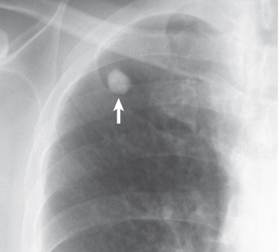 Fig. 4.4, Diffuse calcification from previous tuberculosis. Frontal chest radiograph shows a diffusely calcified right upper lobe nodule (arrow) .