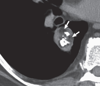 Fig. 4.5, Popcorn calcification in pulmonary hamartoma. Axial CT scan shows a right lower lobe smoothly marginated nodule with several coarse foci of calcification (popcorn calcification). Also note the presence of foci of fat attenuation (arrows). The findings are virtually pathognomonic of hamartoma.