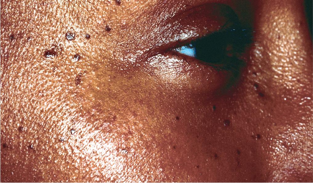 Fig. 5.10, Small, brown papules typical of dermatosis papulosa nigra slowly increased in number and size on the face of this black adolescent. Her parents had similar lesions, which began to appear in late childhood.