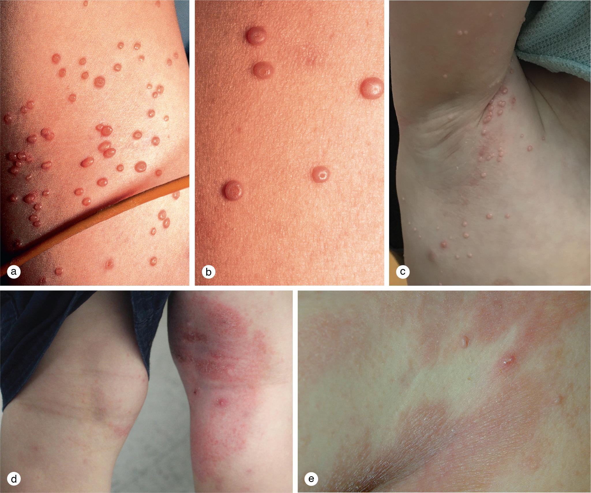 Fig. 5.11, Molluscum contagiosum. (a) Multiple, pearly papules dot the arm of this 8-year-old girl with widespread molluscum. (b) A close-up view demonstrates the central umbilication present on mature molluscum lesions. (c) Note the linear spread of papules on the right axilla, arm, and chest of this child which followed scratching and autoinoculation. (d) Molluscum on the eyelid margin and conjunctivae are particularly irritating and difficult to treat. (e) Red scaly dermatitic patches encircled this toddler’s molluscum shortly before their resolution.