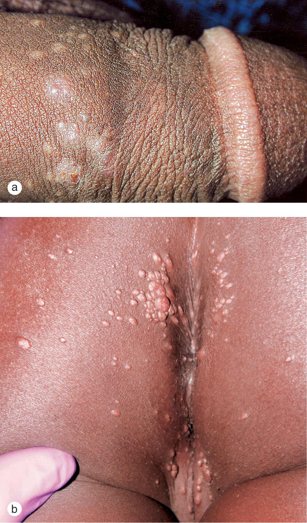 Fig. 5.12, Anogenital molluscum. (a) Molluscum developed on the penile shaft of this sexually active adolescent. (b) A healthy 6-year-old girl with molluscum on the chest and right arm accidentally inoculated lesions onto the anogenital skin.