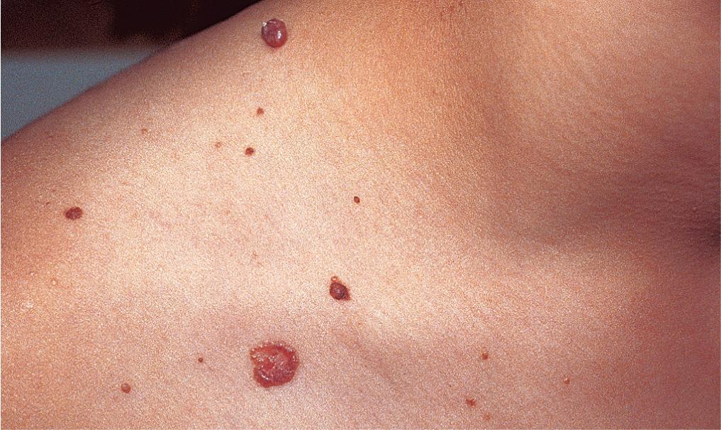 Fig. 5.14, Basal cell nevus syndrome. Numerous 1–3 mm diameter papules composed of proliferating basaloid cells and two larger nodules, which demonstrated changes typical of basal cell carcinoma, are on the shoulder and neck of a 15-year-old girl with basal cell nevus syndrome. In addition to the widespread cutaneous tumors, she had subtle palmar and plantar pits and a history of jaw cysts. Her father, uncle, and grandmother had similar cutaneous lesions.