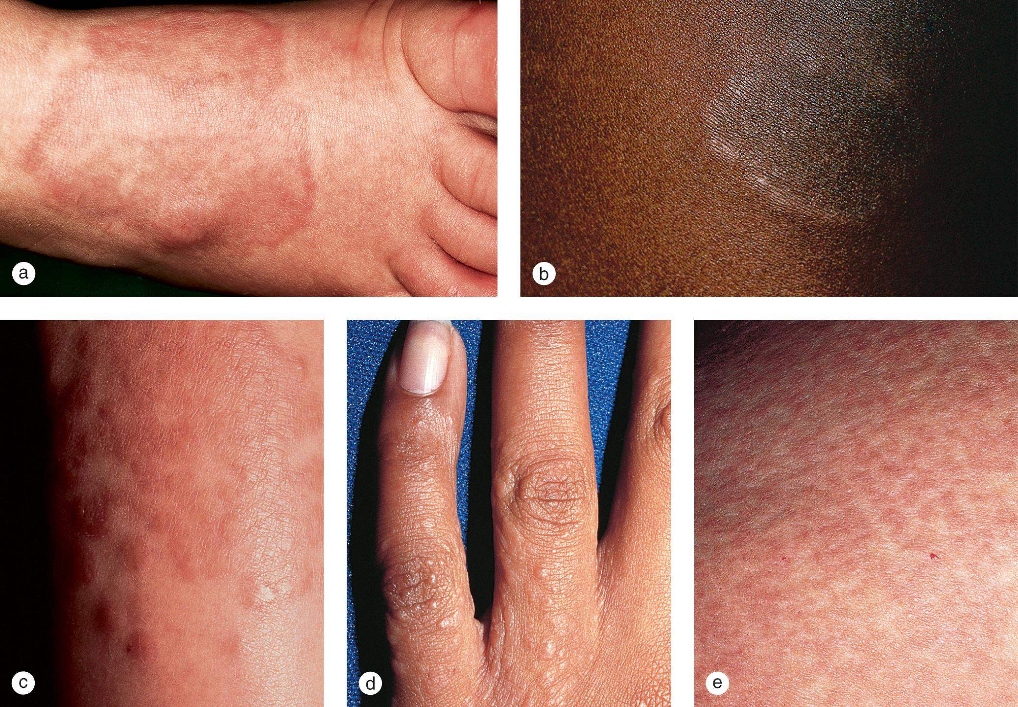 Fig. 5.15, Granuloma annulare. Characteristic, doughnut-shaped, dermal plaques on (a) the foot of a light-pigmented boy and (b) the thigh of a dark-pigmented girl. In both children the epidermal markings are preserved. (c) A large, confluent plaque is developing from merging papules on the arm of a 9-year-old boy. (d) Multiple, asymptomatic 2–4 mm diameter papules erupted on the hand of a teenager. (e) Disseminated granuloma annulare developed in a 20-year-old individual with insulin-dependent diabetes mellitus.