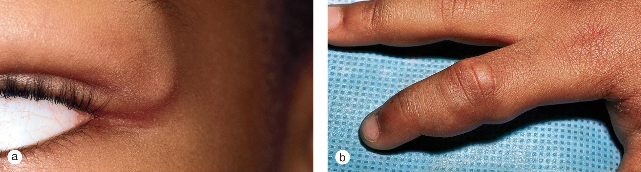 Fig. 5.16, Subcutaneous granuloma annulare. Asymptomatic subcutaneous nodules persisted for over a year (a) on the upper eyelid of a 7-year-old boy and (b) on several fingers of a 10-year-old girl.