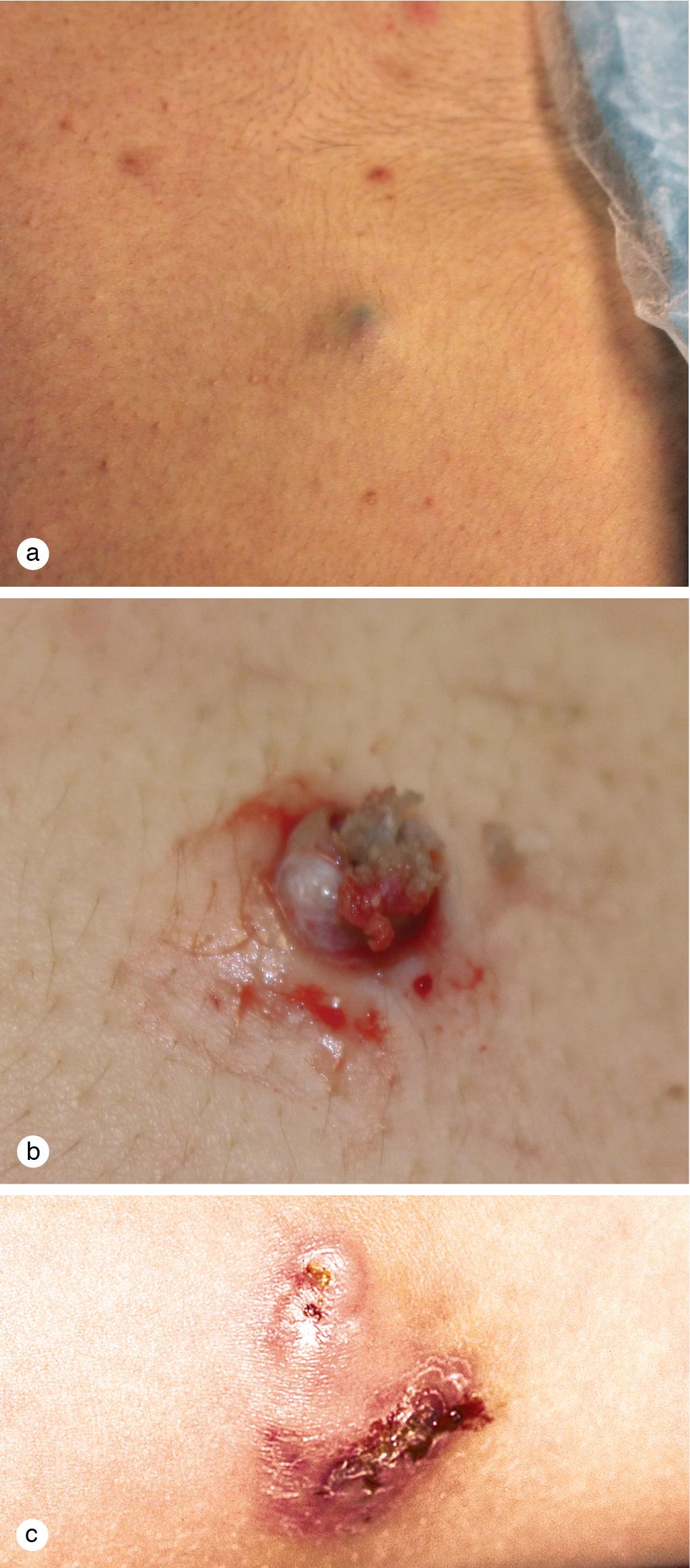 Fig. 5.18, Pilomatrixoma. (a) A pilomatrixoma caused intermittent itching and pain on the chest of this adolescent boy. (b) It was excised uneventfully with complete removal of the cyst lining. (c) This rock-hard nodule on the upper arm of a 5-year-old girl developed a central ulceration.