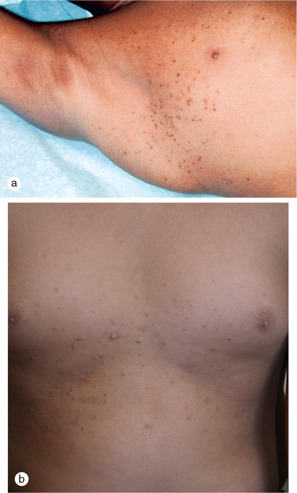 Fig. 5.19, Multiple asymptomatic 1–3 mm vellus hair cysts on the (a) axillae of a 7-year-old boy and (b) the chest of an 11-year-old boy.