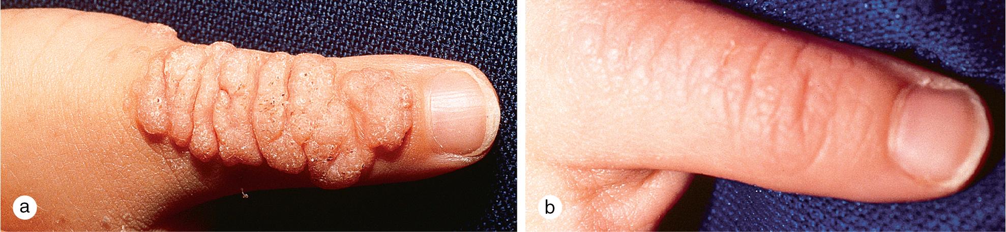 Fig. 5.1, Warts. (a) Multiple common warts grew to confluence on the thumb of a 4-year-old boy. (b) Shortly before surgery was scheduled, the warts began to regress without treatment.