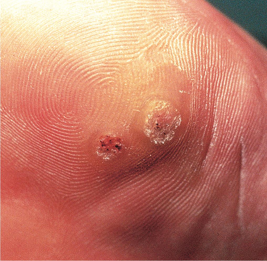 Fig. 5.2, Plantar warts. Two painful papules are seen over the ball of the foot. Note how they interrupt the normal skin lines.