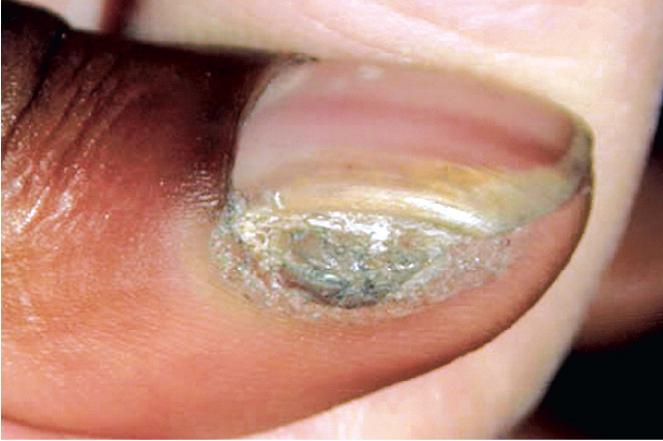 Fig. 5.3, Subungual common wart. This wart persisted despite repeated painful treatments with liquid nitrogen. A year later it resolved after therapy was discontinued.